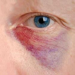 Hematoma